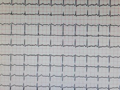 EKG-Ableitung bei einem Kind mit Elektroden auf dem Brustkorb